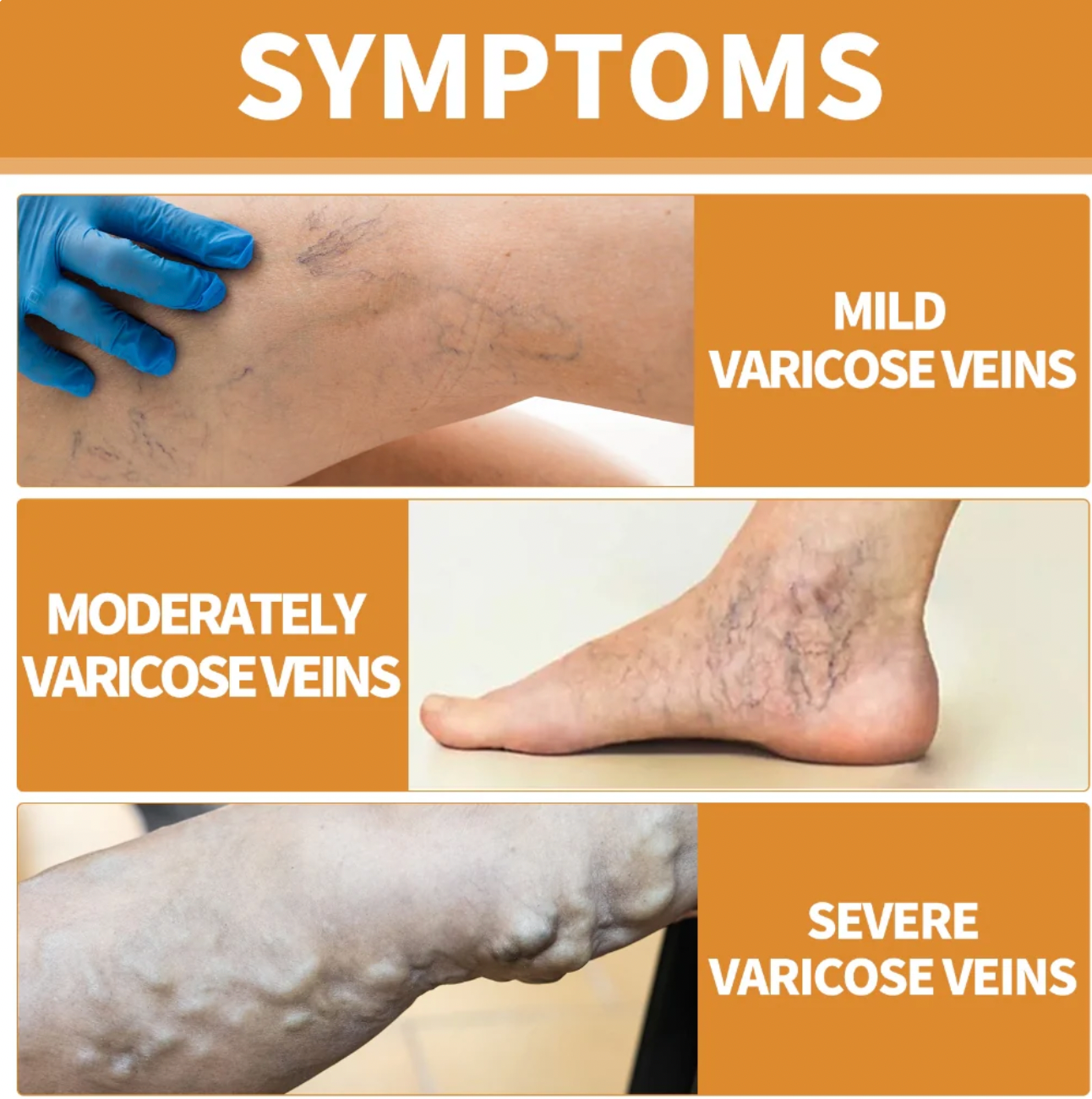Turmeric Varicose Vein Relief Spray (BUY 1 GET 2 FREE 🎁)
