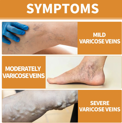 Turmeric Varicose Vein Relief Spray (BUY 1 GET 2 FREE 🎁)