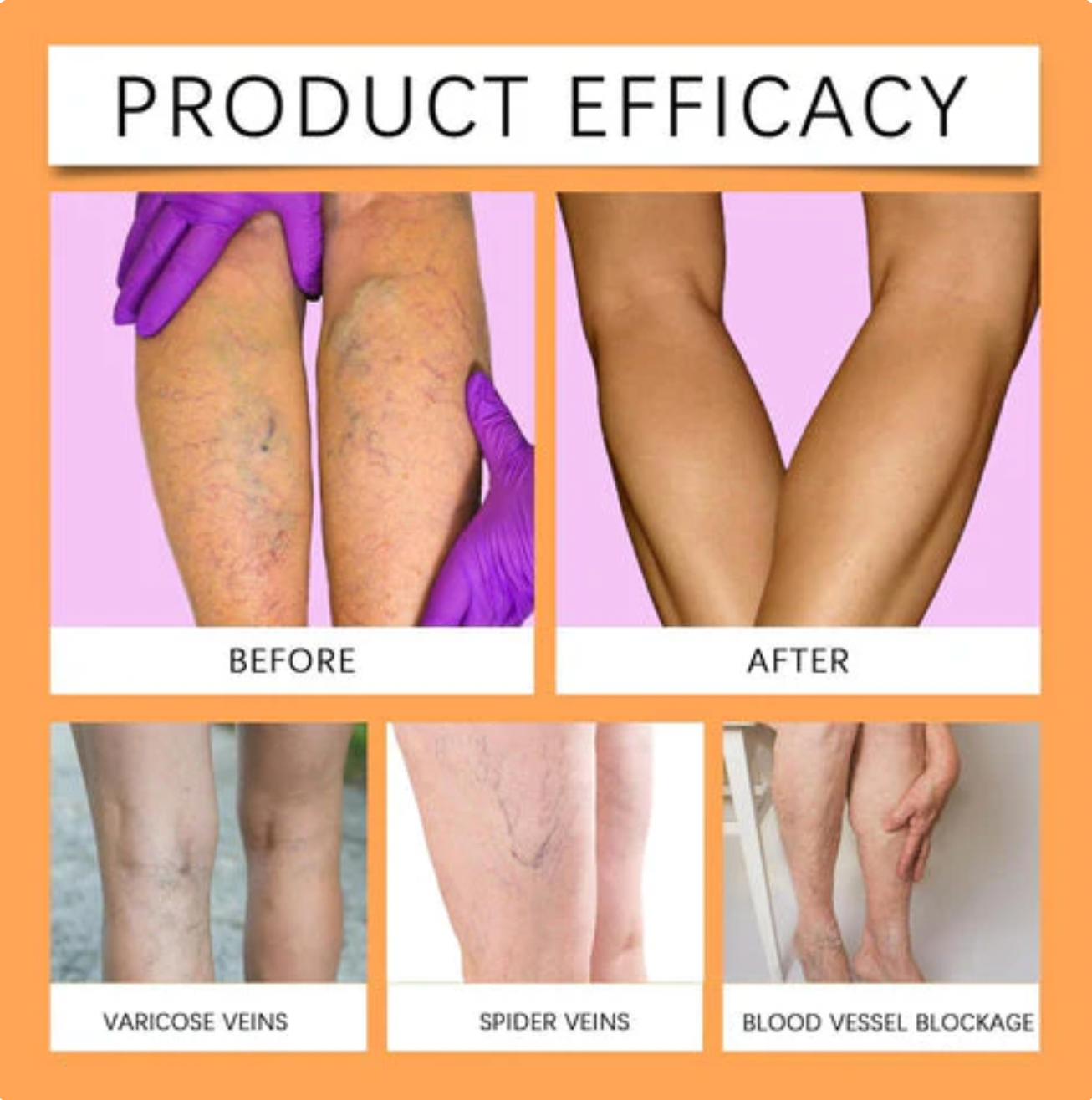 Turmeric Varicose Vein Relief Spray (BUY 1 GET 2 FREE 🎁)