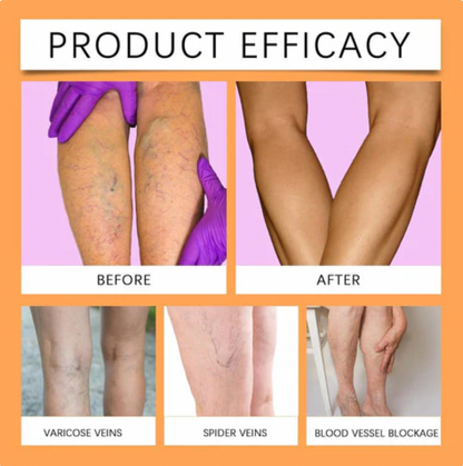 Turmeric Varicose Vein Relief Spray (BUY 1 GET 2 FREE 🎁)